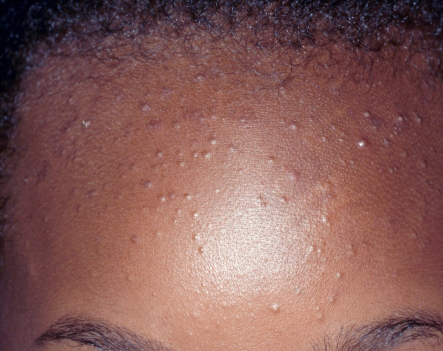 Acne soap
